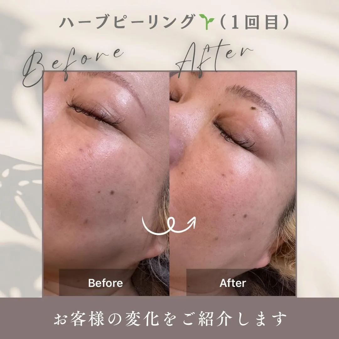 ベルナハーブピーリング（ハード）1回目の変化