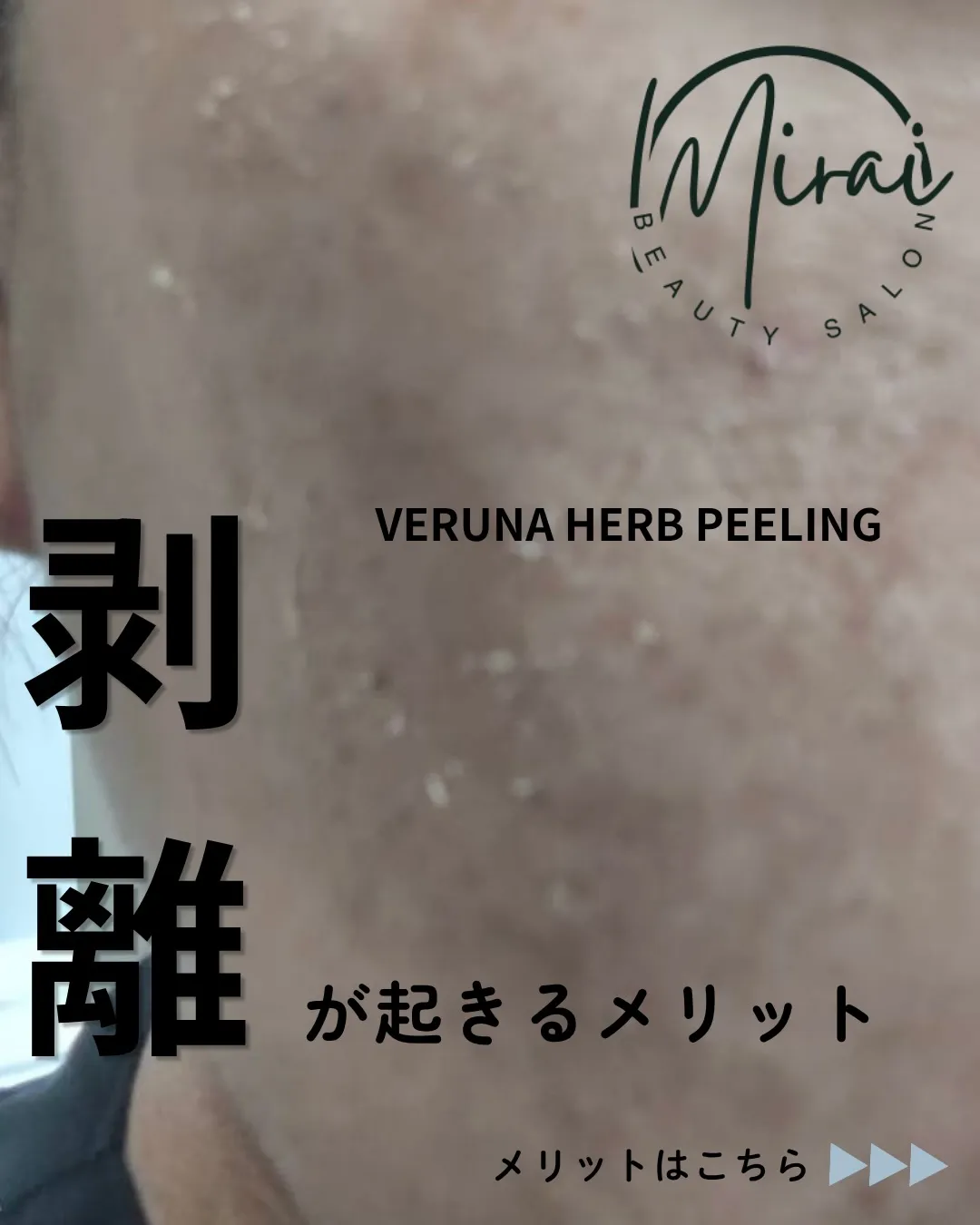 【剥離＝デメリットだと思っていませんか？】