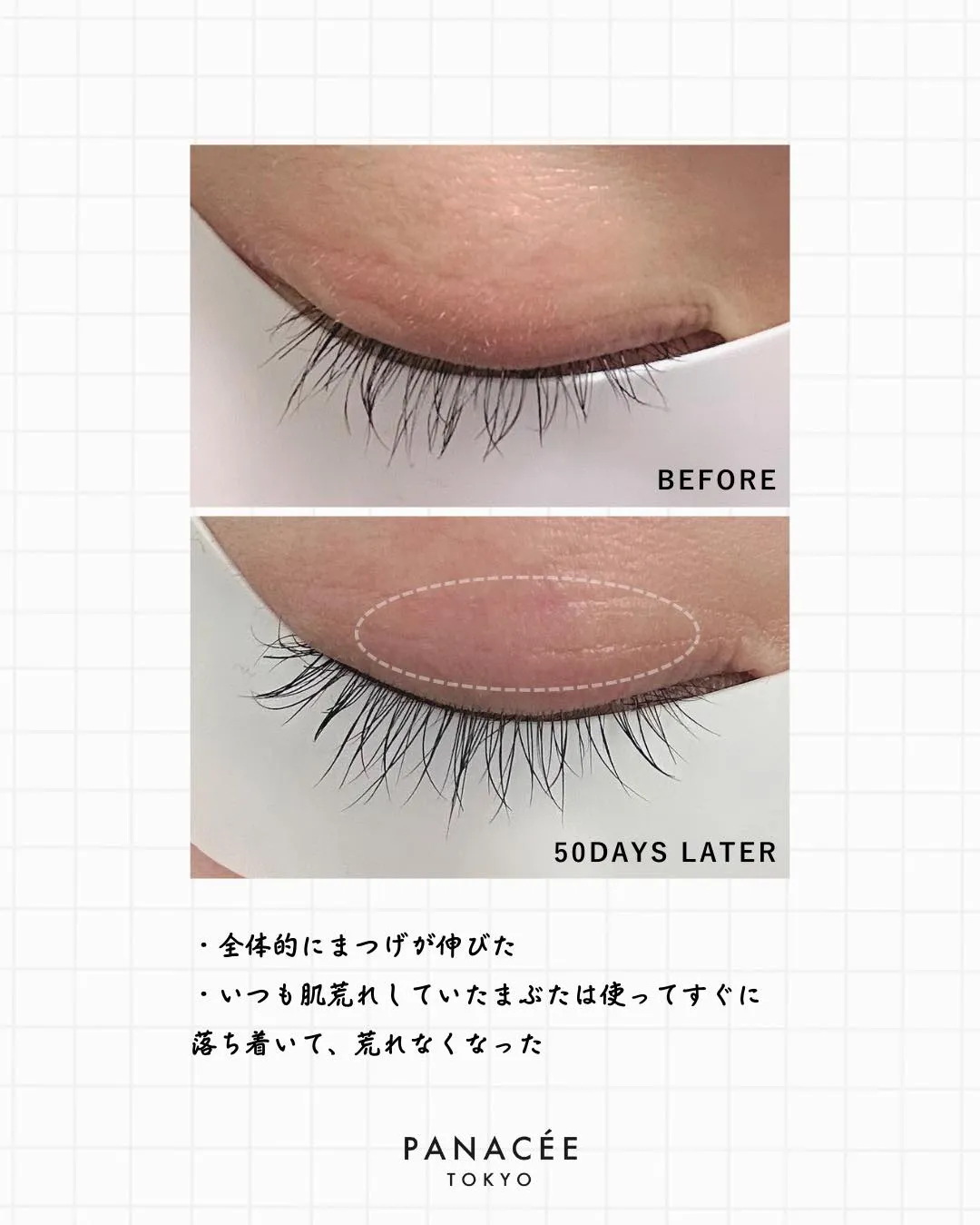 「まつげを伸ばしたいけれど、色素沈着や肌荒れが気になる…」